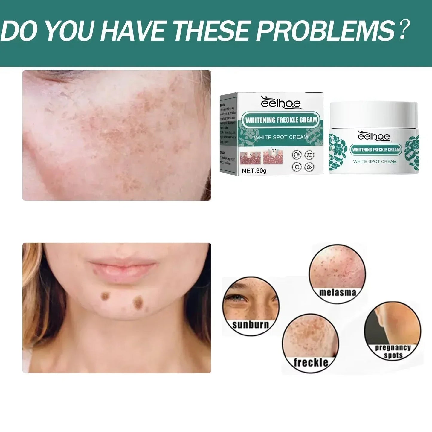 Eelhoe Niacinamide Melasma Brightening Cream Reduce Melanin Brighten Cream Lighten Dark Skin Chloasma Serum Skin Care Produce - Bakka shop