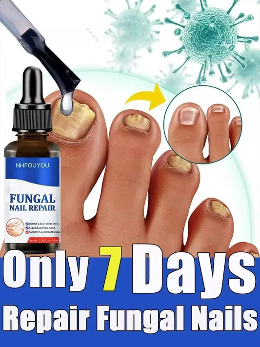 Toenail Nail Fungus Treatment Repair Fingernail Device Toenail Treatment for Foot Nail Fungus Essential Oil Onychomycosis Care - Bakka shop