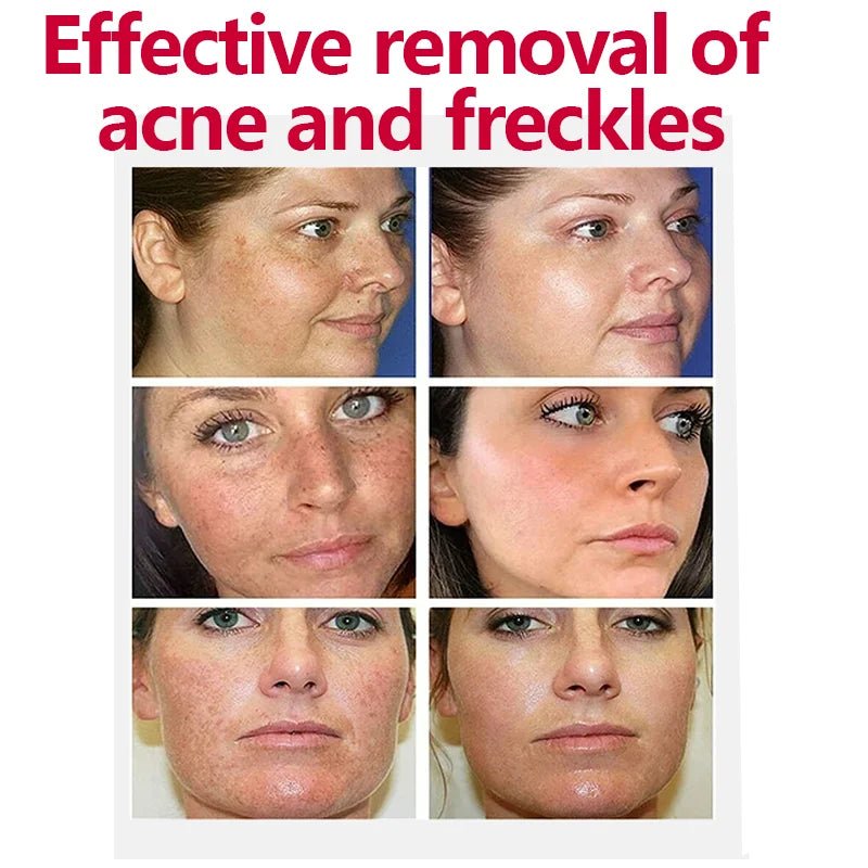Whitening Freckle Cream Effectively reduces dark spots Brightens and revitalizes dull skin Hydrates and nourishes the skin - Bakka shop